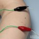 Electroacupuncture in Berkeley California