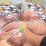 cupping