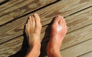 Acupuncture can treat gout along with Chinese Medicine. Contact Tao to Wellness in Berkeley for treating gout with acupuncture and herbs.