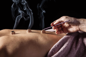 Close-up of a practitioner at Tao to Wellness performing moxibustion therapy on a patient's back, with smoking moxa cones placed on the skin to promote healing and relaxation.