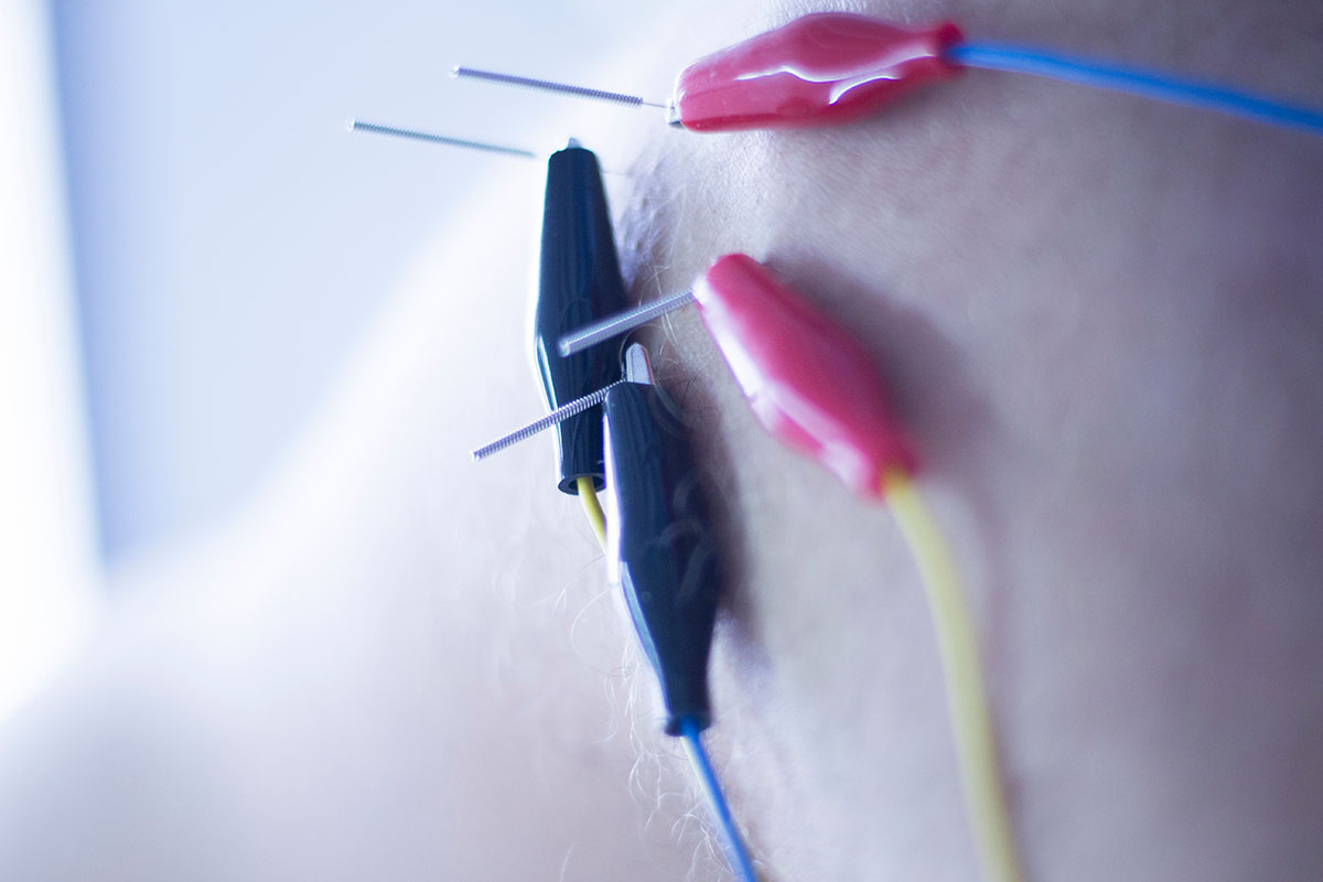 Close-up of acupuncture needles connected to electric stimulation clips on a patient’s skin, illustrating electroacupuncture therapy for pain relief at Tao to Wellness in Berkeley, CA.