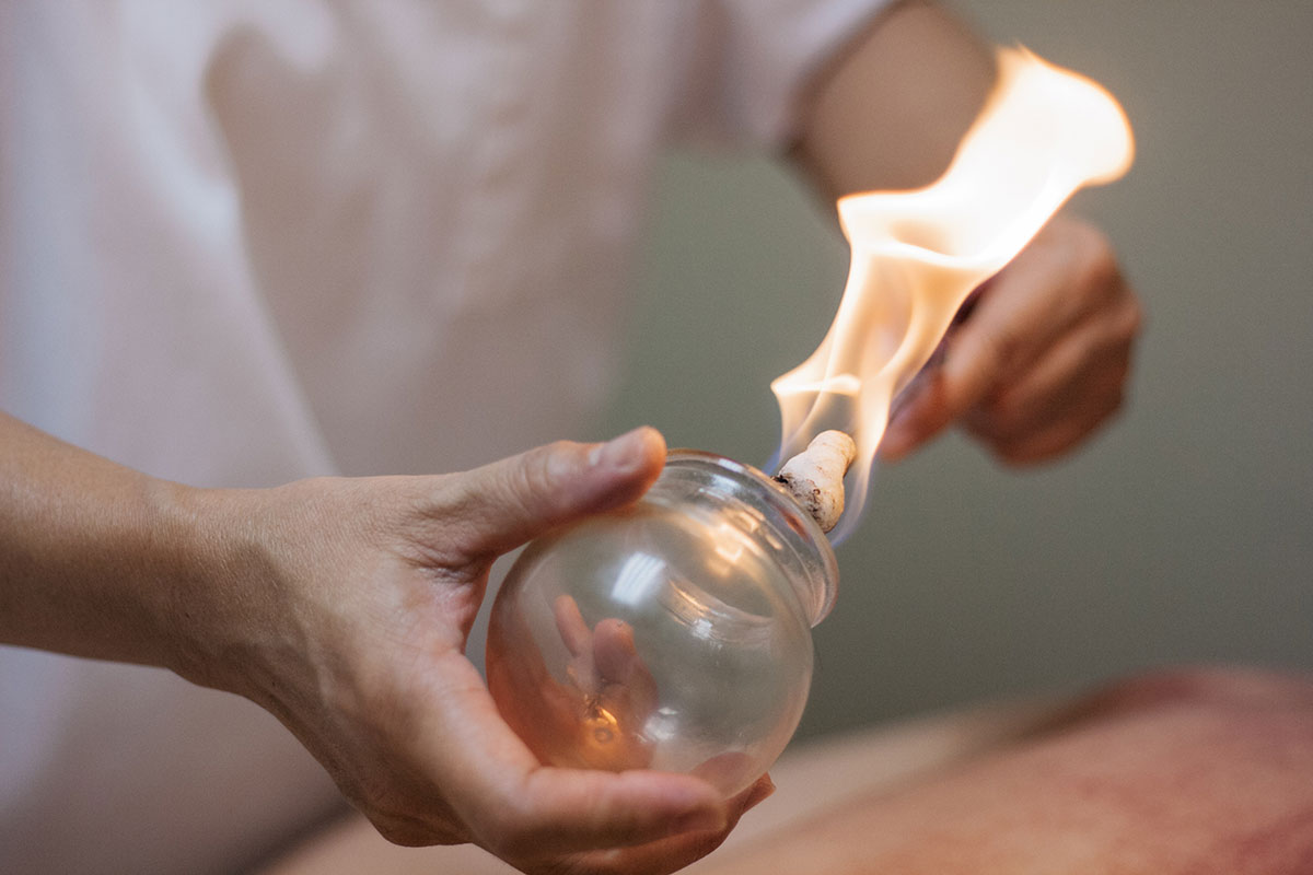 Acupuncturist in Berkeley, CA inserting fire in glass cup to create suction for cupping therapy treatment.