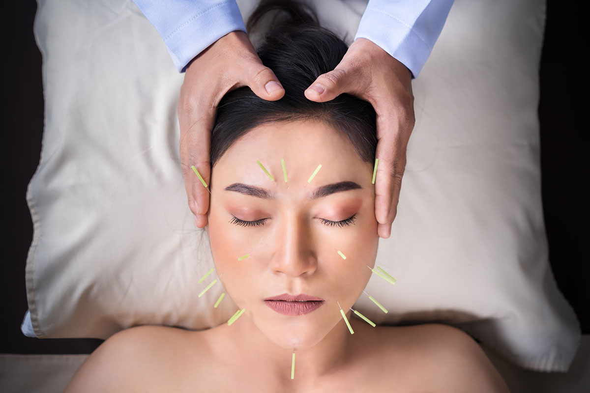 Young woman undergoing acupuncture treatment on face