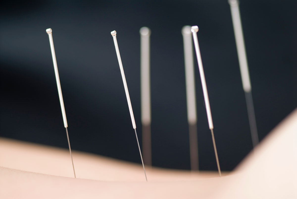 A patient getting acupuncture at Tao to Wellness