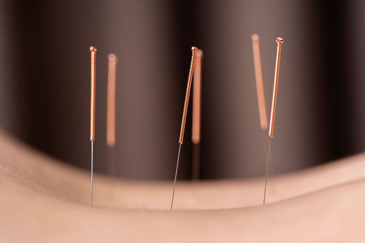 Cose up woman undergoing acupuncture treatment on back