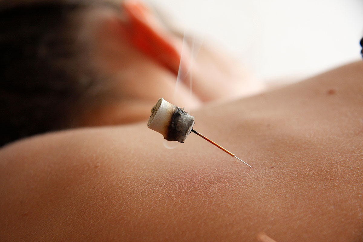 Close-up of a burning moxa cone placed on an acupuncture needle inserted into a patient's back, demonstrating moxibustion therapy for pain relief and relaxation.