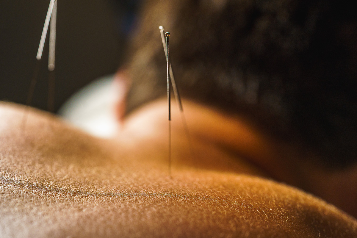 Male fertility acupuncture treatment.