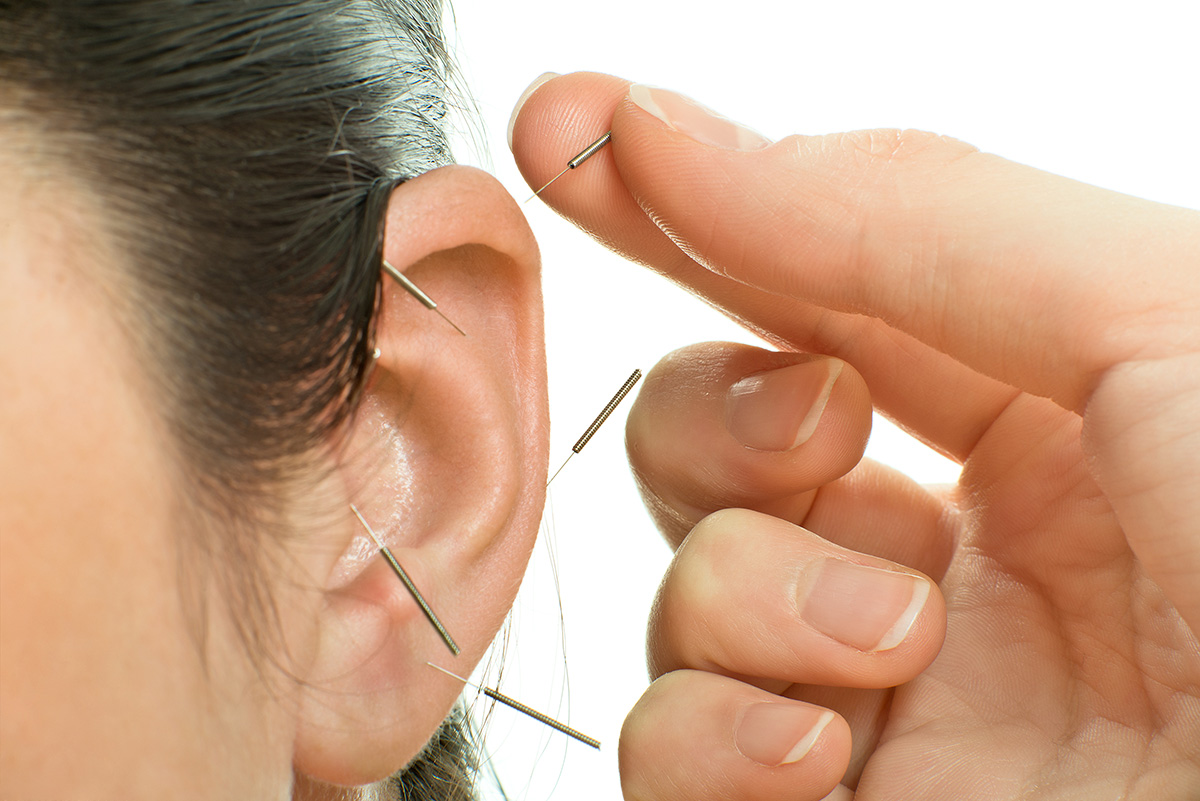Acupuncture therapy on auricle.