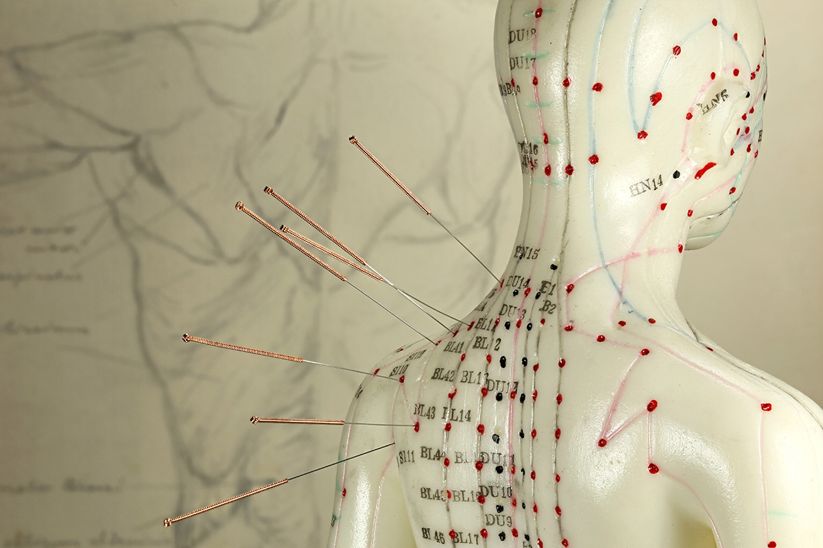 Acupuncture model with needles in the shoulder.